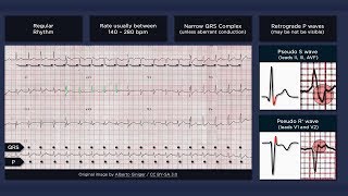 Atrioventricular Nodal Reentry Tachycardia AVNRT ECG [upl. by Ernie]