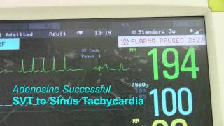 SVT or Supraventricular Tachycardia [upl. by Salvidor]