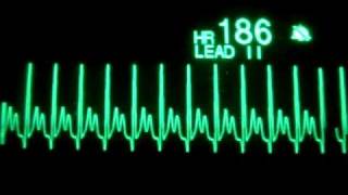 Atrial Tachycardia [upl. by Braun294]