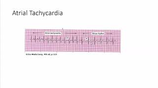 atrial tachycardia [upl. by Konstantine]