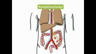 Dickdarmkrebs  DrOweira Plattform [upl. by Rea]