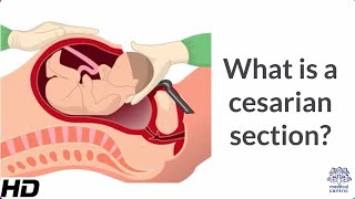 What is a Cesarian Section [upl. by Eiramnwad]