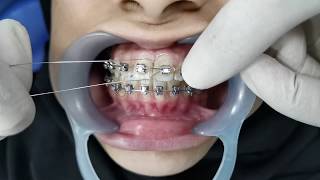 Orthodontic Ligation [upl. by Belak]