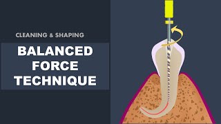 Balanced Force Technique  Cleaning and Shaping [upl. by Godfrey]