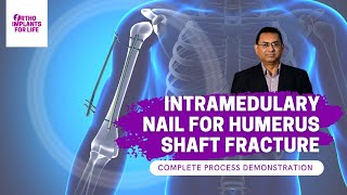 Intramedullary Nail For Humerus Shaft Fracture Procedure [upl. by Ennyroc]