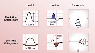 Intro to EKG Interpretation  Chamber Enlargement [upl. by Nylimaj]