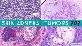 What is Carcinoma in situ  Pathology mini tutorial [upl. by Meris]