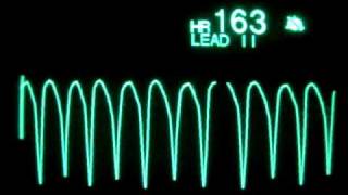 Ventricular Tachycardia [upl. by Audry]