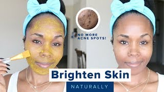 How to Brighten Skin Reduce Acne Scars Hyperpigmentation amp Discoloration  Home Remedies [upl. by Brandyn311]