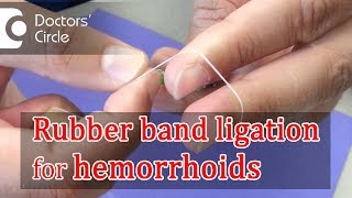 What is Rubber Band Ligation  Dr Rajasekhar M R [upl. by Siobhan]