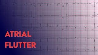 Atrial Flutter  EKG ECG Interpretation [upl. by Annuahsal113]