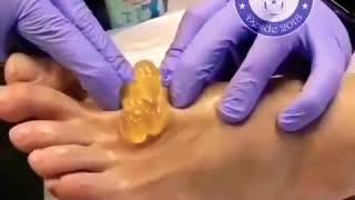 Synovial cyst removal [upl. by Edahsalof]